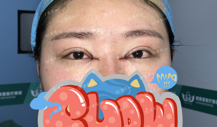 开眼角过大图片,开眼角过大修复效果图