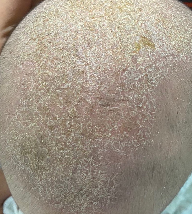 婴儿脂溢性皮炎能治好吗,脂溢性皮炎与性激素水平