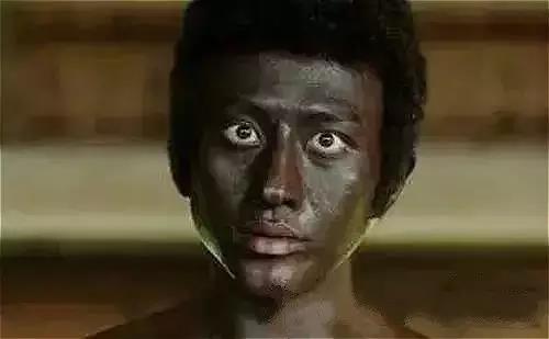 剖腹产的疤痕增生怎么除疤,疤痕体质如何才能正确除疤