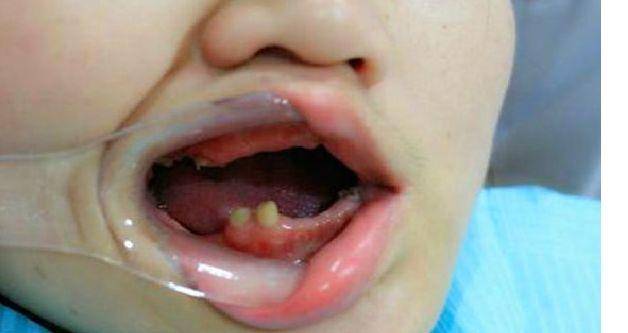 6岁男童被查出牙龈癌晚期,6岁孩子牙龈癌