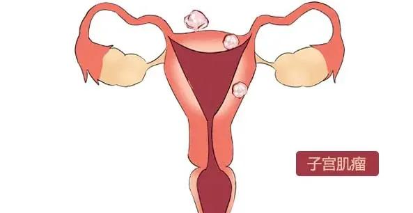 备孕却发现子宫肌瘤需要处理吗,备孕有子宫肌瘤能每天喝豆浆吗
