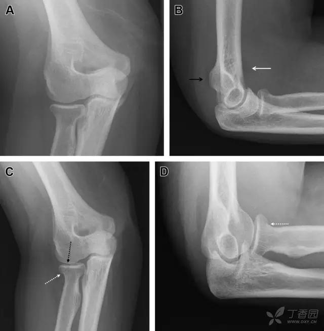 值夜班急救措施,放射科容易漏诊的骨折