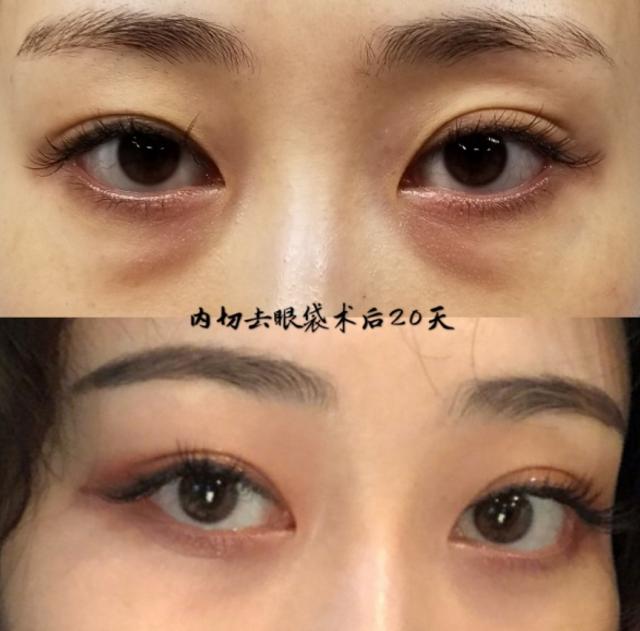 眼袋显老10岁三种方法帮助改善,眼袋显老怎么解决