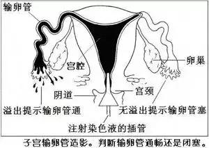4步讲解输卵管造影检查过程