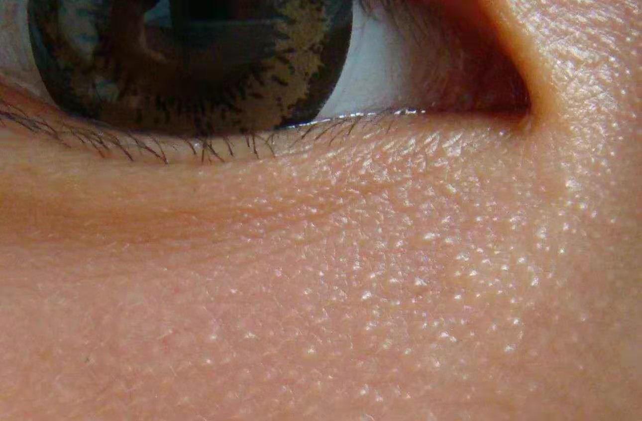 毛孔粗大脂肪粒多用什么护肤,护肤秘方7天溶解顽固脂肪粒