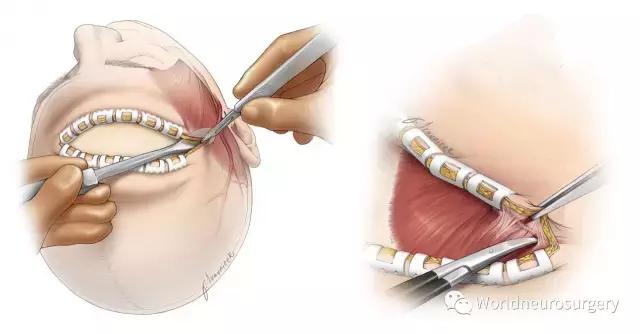 翼点入路的开颅要点,翼点开颅详解图