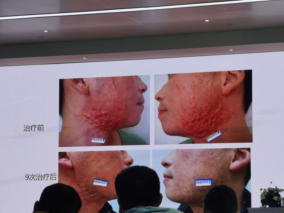 冷冻祛痣和脉冲染料激光,脉冲染料激光祛鲜红斑痣后有红印