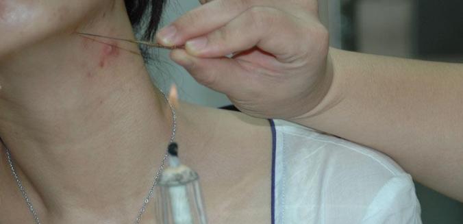 火疗引火烧身,引火归元针治疗三种病