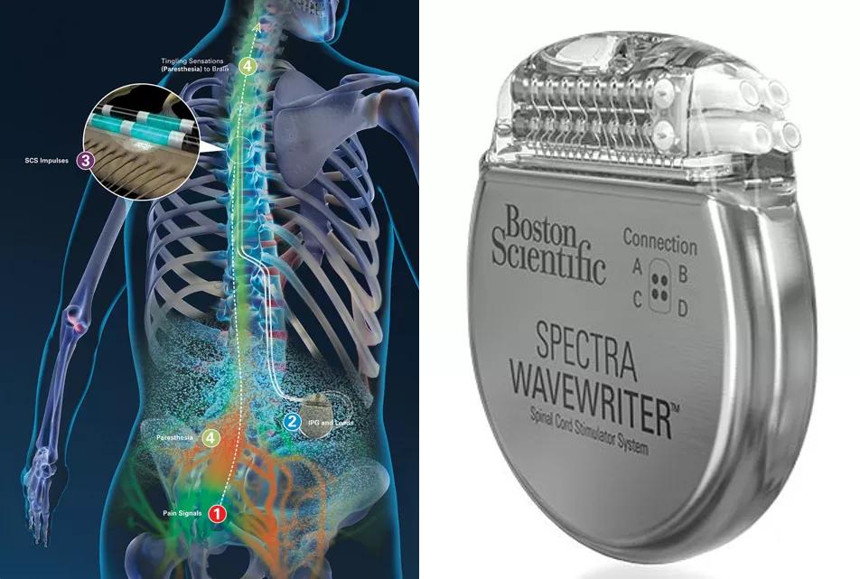 神经调控技术发展前景,神经调控前沿疗法
