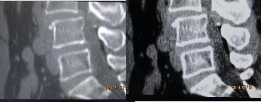 颈椎腰椎疾病ct及mri诊断,腰椎ct可以发现肠部病变吗