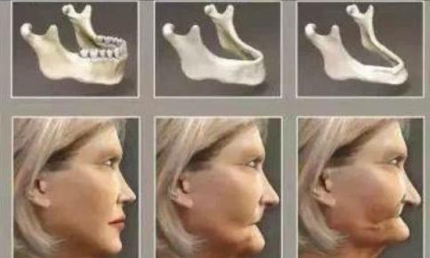 种牙内幕,种植牙的猫腻在什么地方