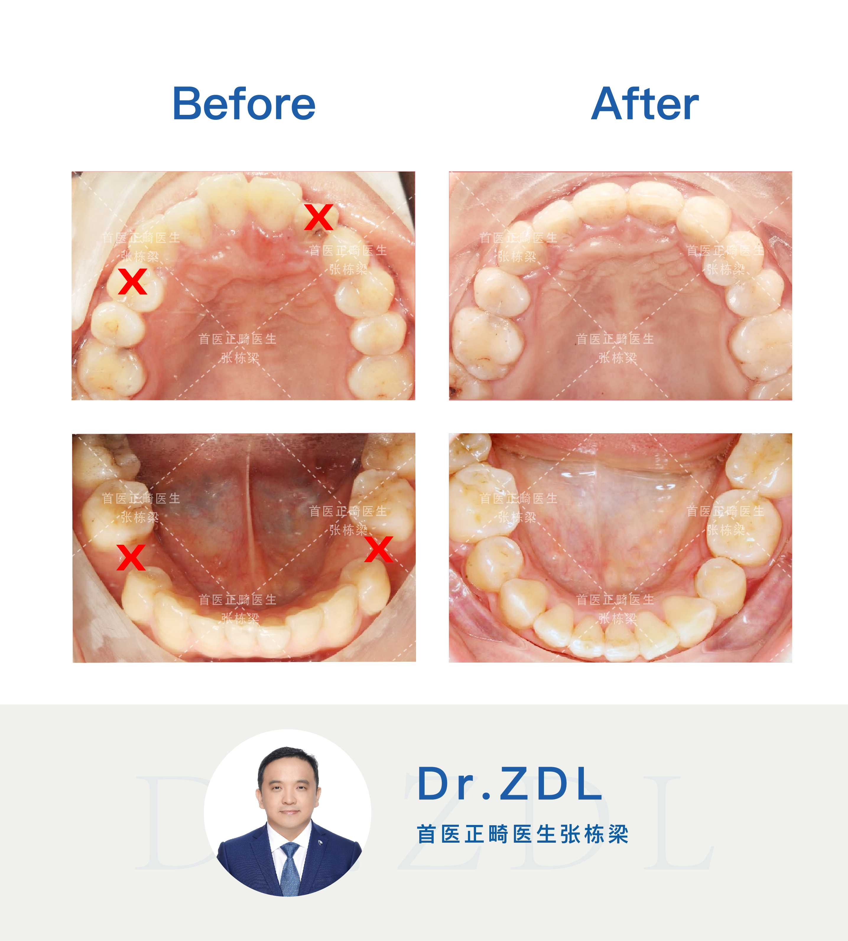 24岁戴牙套矫正效果能有效吗,40岁戴隐形牙套矫正牙齿经历