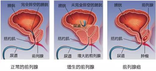 男人一生中不能忽略这些关于前列腺的问题