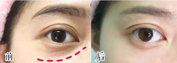 刘亦菲保养皮肤的方法,30岁皱纹多怎么修复