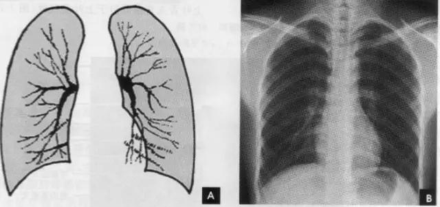 x线影像解剖大全,胸部x线怎么看懂图解