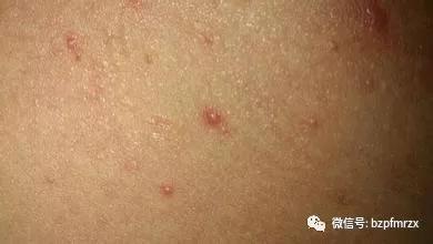 皮肤科里病人会传染吗,皮肤科医生容易得皮肤病吗