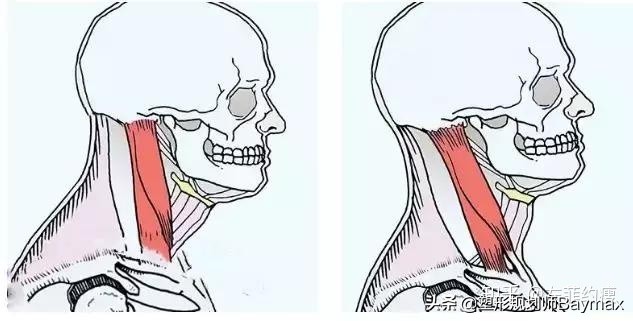 纠正颈部前伸最简单有效的方法,颈部前伸怎么办
