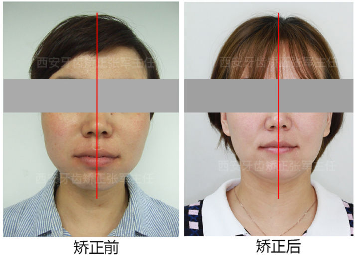 西安透明式牙齿矫正器龅牙,昆明牙齿矫正改变脸型