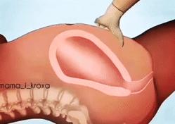 胎盘滞留子宫有什么后果,胎盘剥离不全为什么导致胎盘滞留