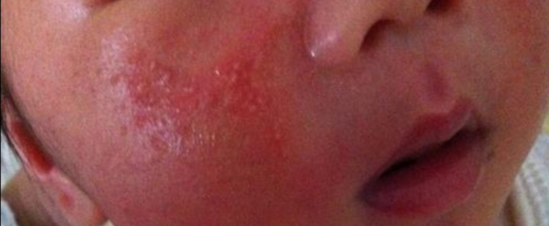 儿童湿疹常见的三大原因,家长要如何护理湿疹宝宝比较好