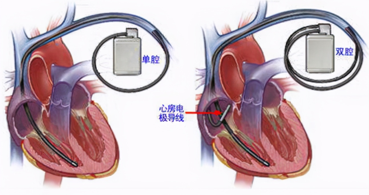 埃里克森晕倒做了什么样的手术,埃里克森植入的是全皮下icd吗