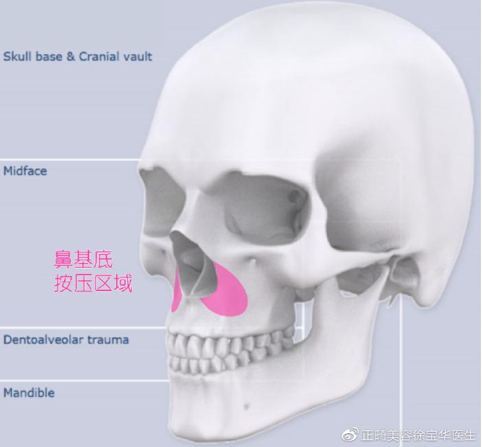 骨性地包天不做正颌手术最好方法,骨性地包天不做手术可矫正吗