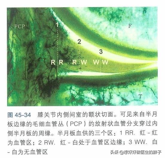 半月板三度撕裂该如何保守治疗,半月板三度撕裂还可以保守治疗吗