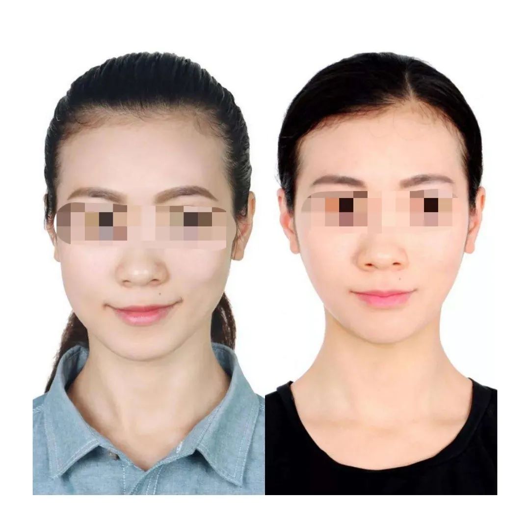 矫正脸部歪斜手法,改善脸歪大小脸动作