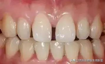 牙齿以前齐现在不齐是什么原因,牙齿排列整齐牙缝大前门牙凸