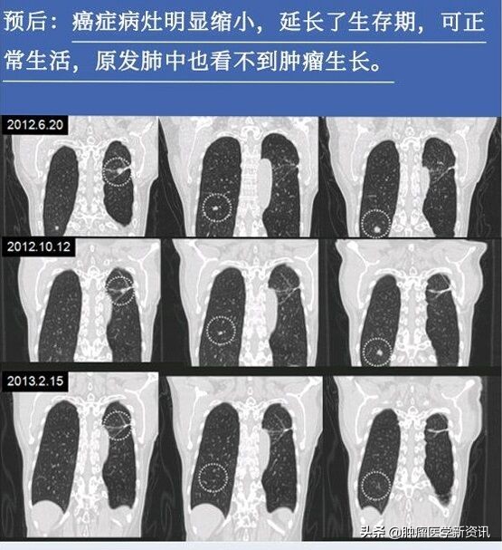 alk阳性肺癌能用免疫治疗吗,alk阳性肺癌手术后复发率