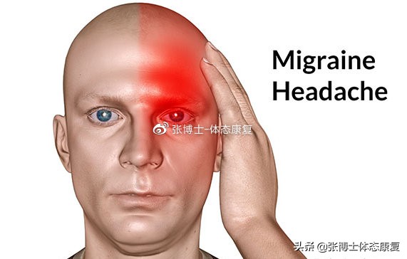 运动性头痛治疗,运动治愈偏头痛