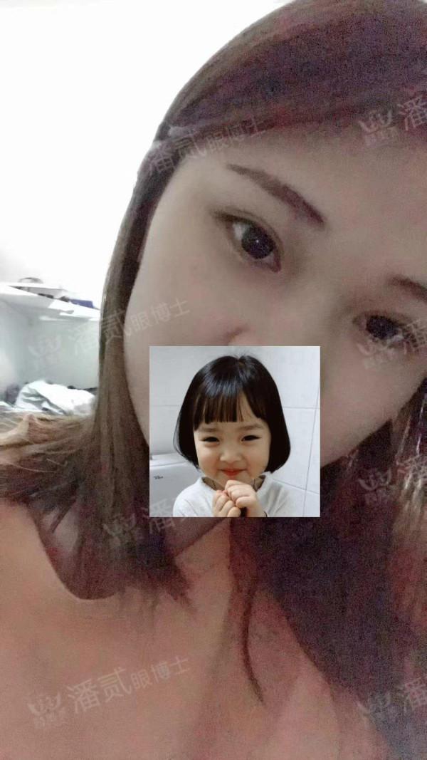 什么样的肿眼泡适合全切,什么样的肿眼泡不用动提肌