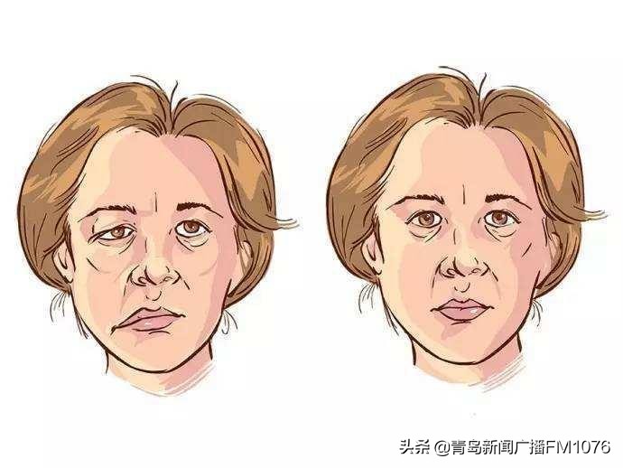 大妈脸不停抽搐，原是耳朵里藏了个大肿瘤，市立专家挑战高难度走位巧摘瘤