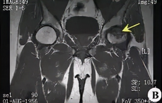股骨头坏死和腰间盘突出症状区别,椎间盘突出和股骨头坏死症状区别