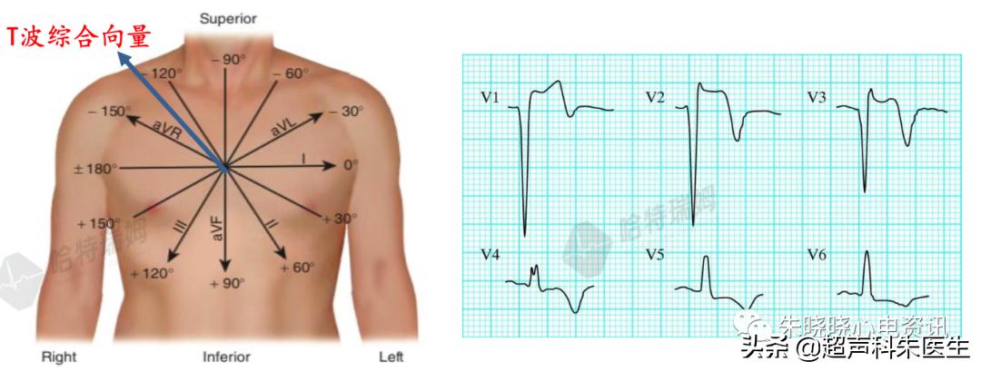 t波倒置诊断,t波倒置如何区分严重程度