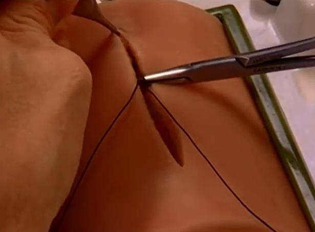 剖腹产用美容线好还是拆线比较好,剖腹产美容线和拆线的区别