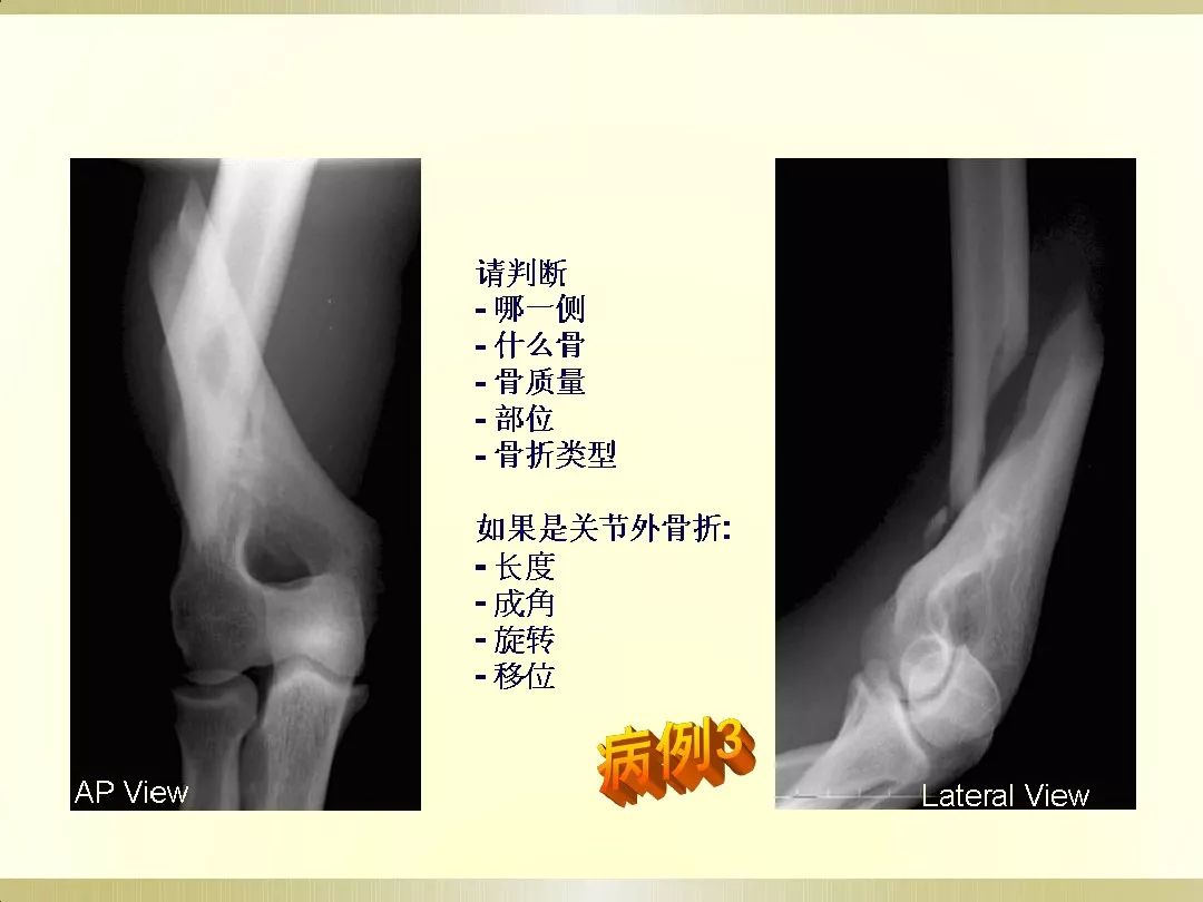 骨科x光片读片技巧,放射科骨科读片教程