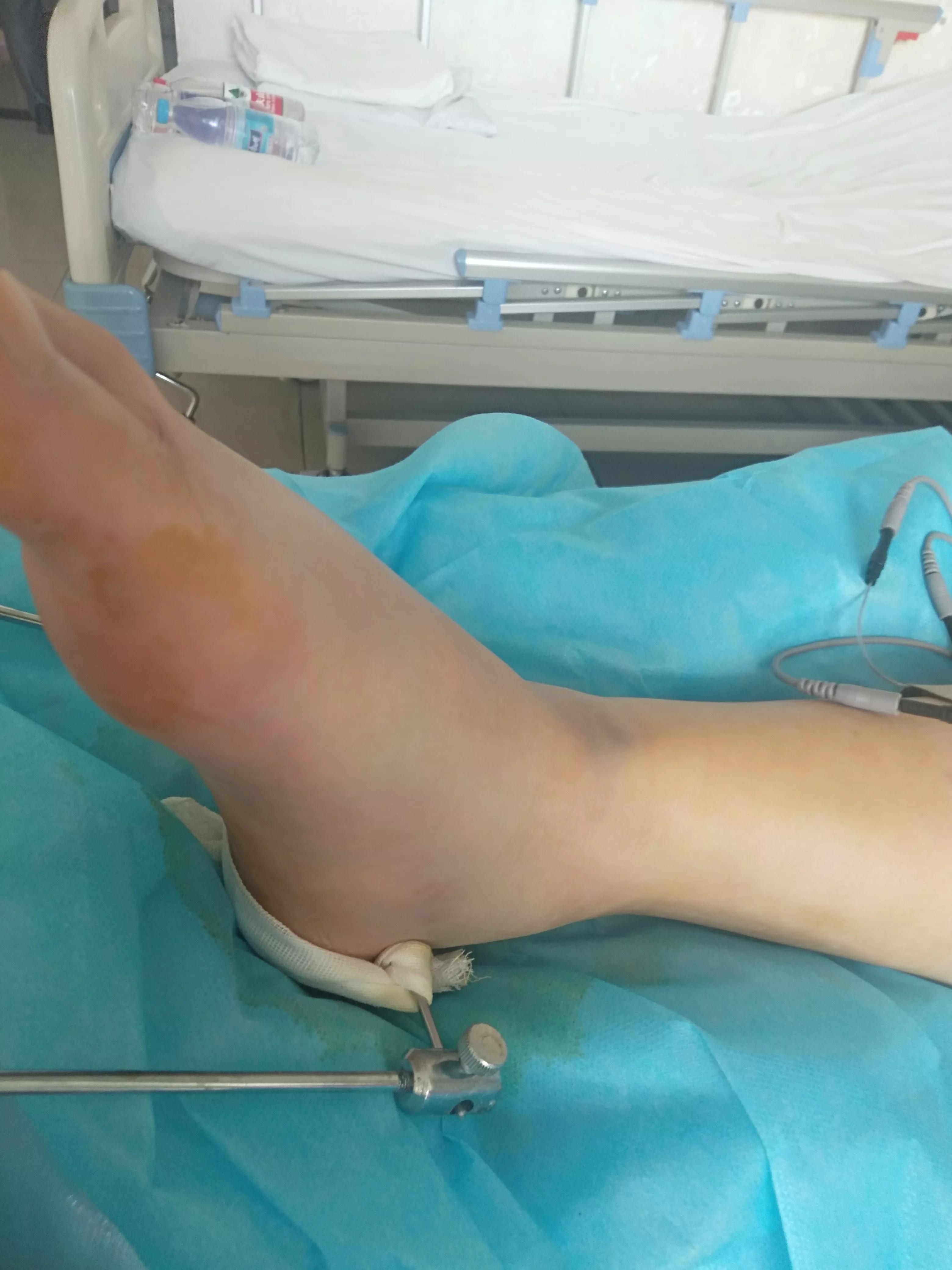 骨折病人完整病历,骨折患者的心路历程