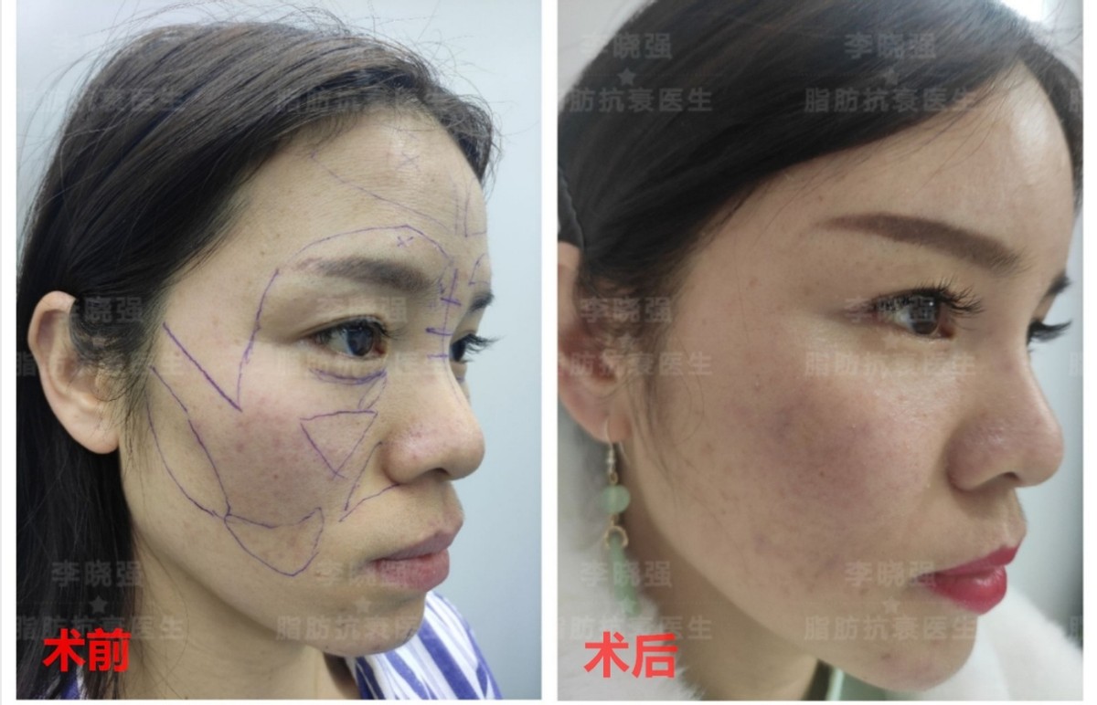 千万不要做减重手术,千万不要做自体脂肪填充