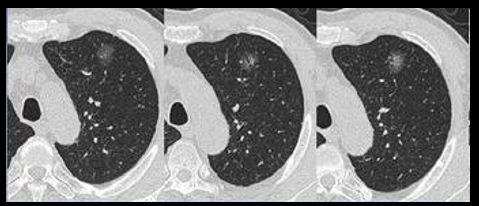 华西廖正银教授治肺结节,华西医院肺癌专家唐小军