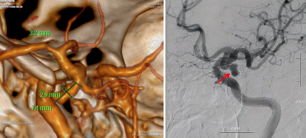 眼皮突然下垂看东西重影,突然大小眼右眼眼皮耷拉