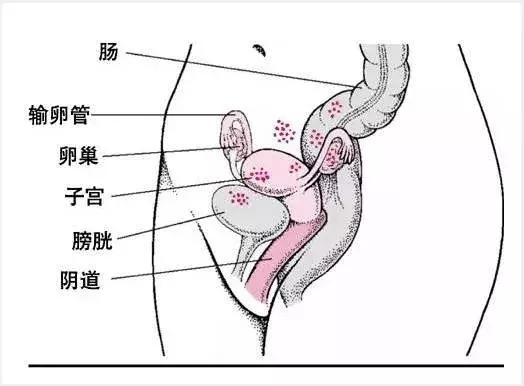 子宫腺肌症吃唯散宁几年,唯散宁治疗子宫肌瘤吗