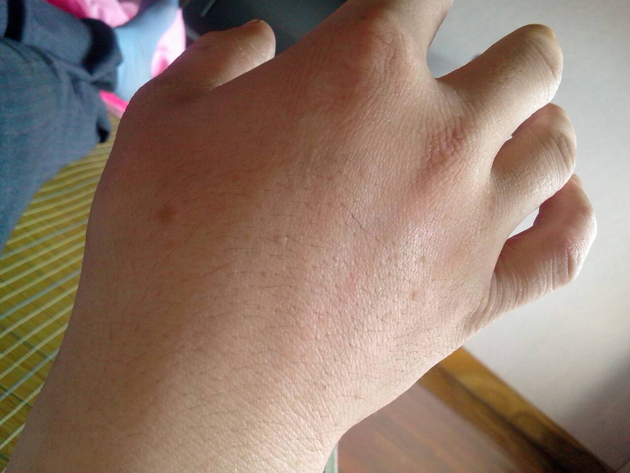 鱼鳞病是基因突变还是伴性遗传,板层型鱼鳞病可怕吗