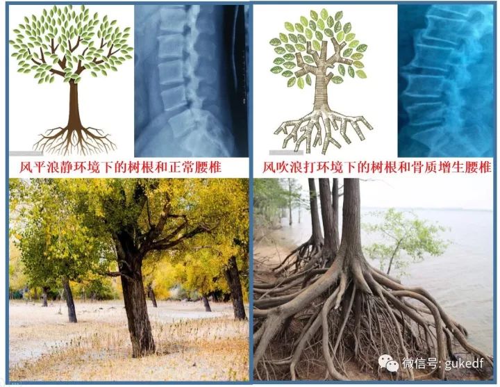 长骨刺的根本原因是什么怎么解决,骨刺到底是不是病