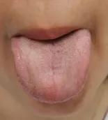 手上长水泡很痒怎么治疗,手上长冻疮又痒又痛又肿怎么办