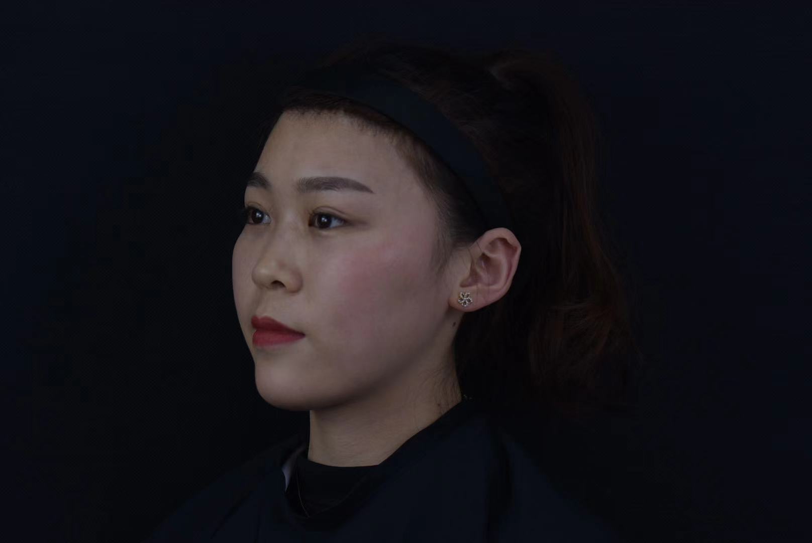 玻尿酸隆鼻鼻子变宽怎么办,玻尿酸隆鼻变宽了还能隆鼻吗