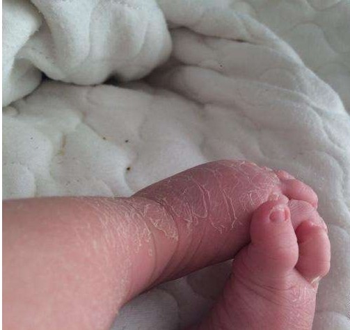 冬天宝宝怎么防皴裂,孩子冬天皮肤皲裂怎么办