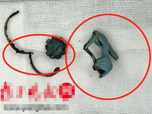 一岁小孩吞无线耳机,男孩误吞无线耳机