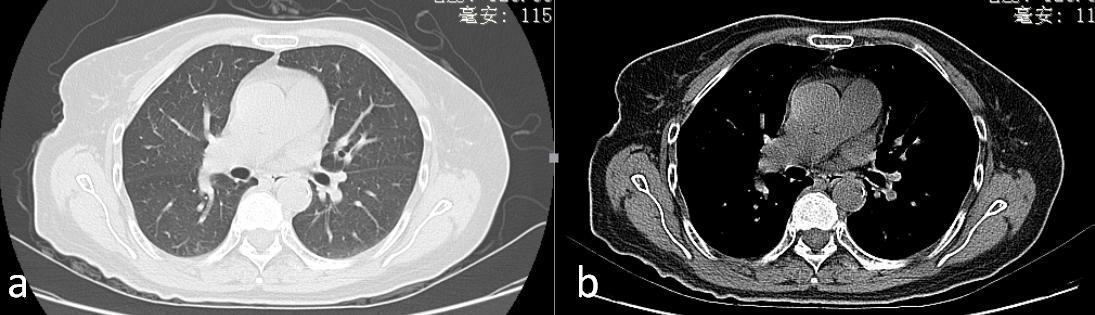 肺癌！已经发了CT诊断报告，还有必要做穿刺？不算重复吗？