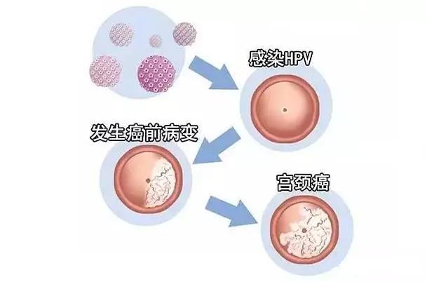 hpv和tct检查都没事但是有宫颈癌,hpv52阳tct不正常还可以打九价吗